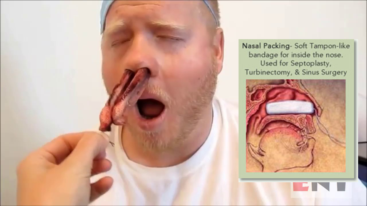 Lavado nasal con jeringa adulto